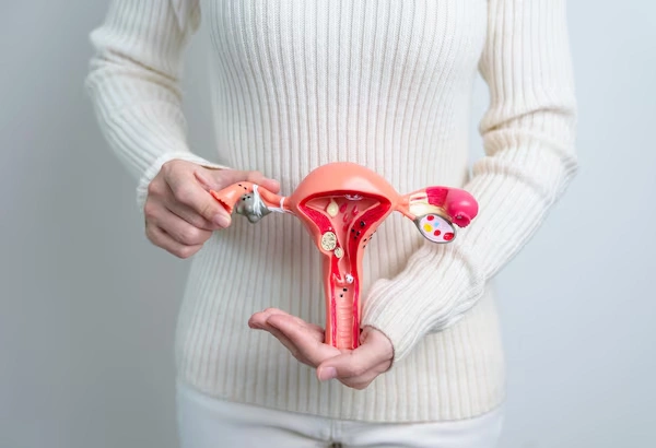 PCOS or PCOD Treatment